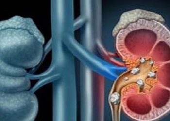 مبتلایان به «سنگ کلیه» چی بخورند؟