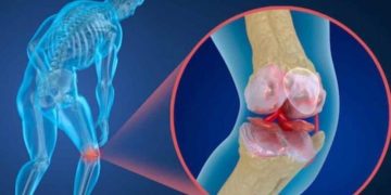 شکستگی ناشی از پوکی استخوان سبب تغییر کیفیت زندگی افراد می شود